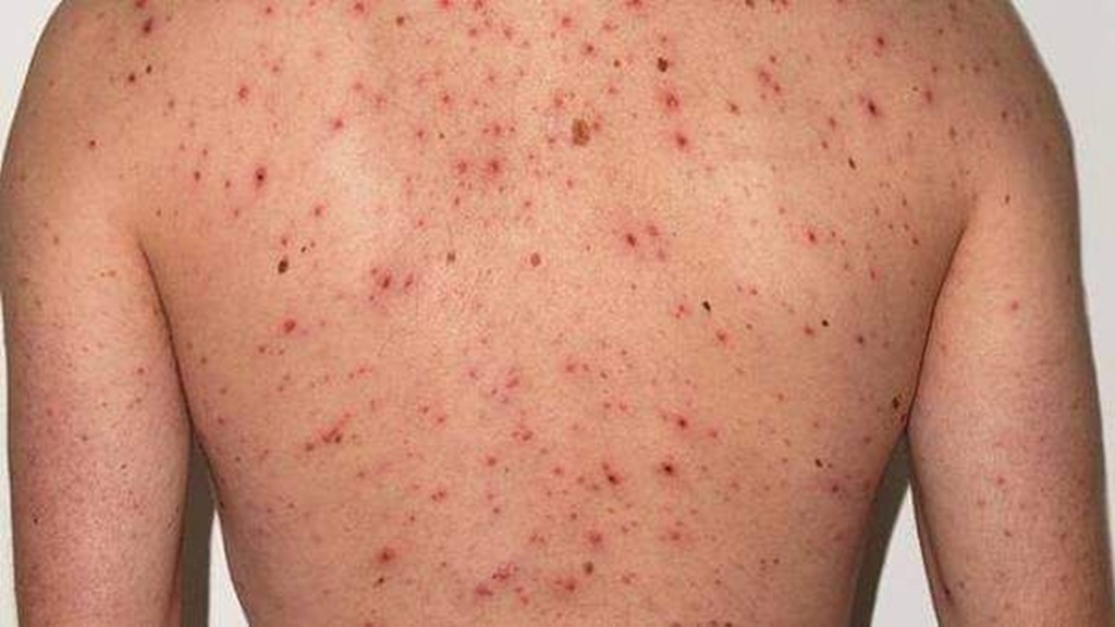 Población indígena de Guerrero en grave riesgo por incremento de sarampión