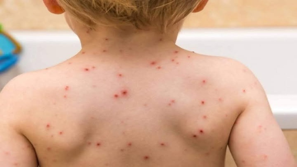 Ocupa Guerrero tercer lugar nacional en casos de sarampión con 248 confirmados